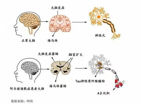正常大脑与阿尔茨海默症患者大脑和神经元生理结构.png